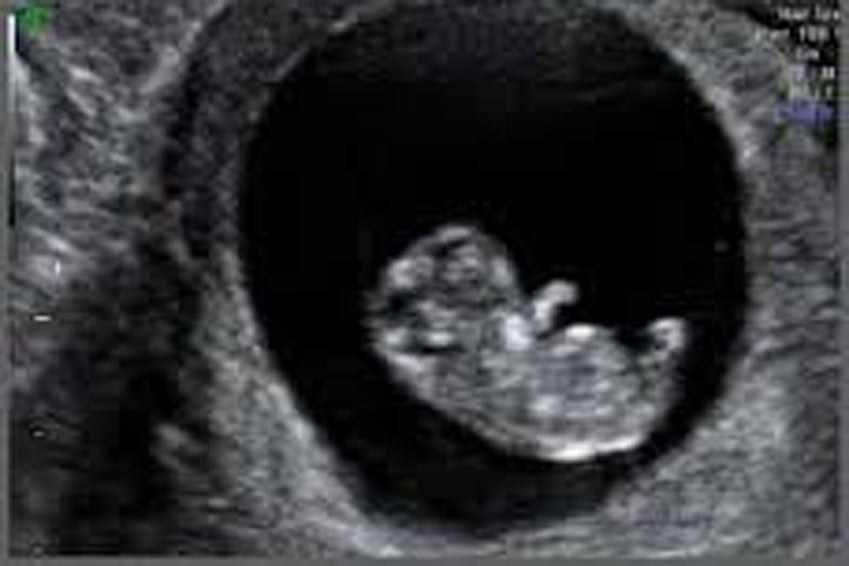 Ultrasound Week By Week - What will I see at an Early Scan?