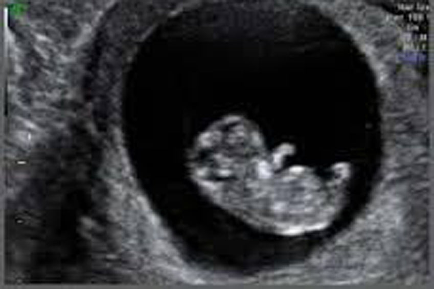 Early Pregnancy Scans - Why have one?