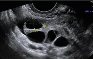 Endometrial Lining Scan & Follicle Tracking